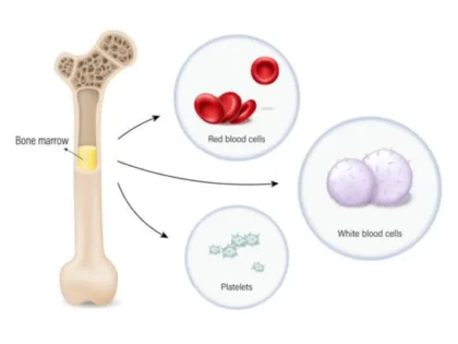 Aplastic anemia