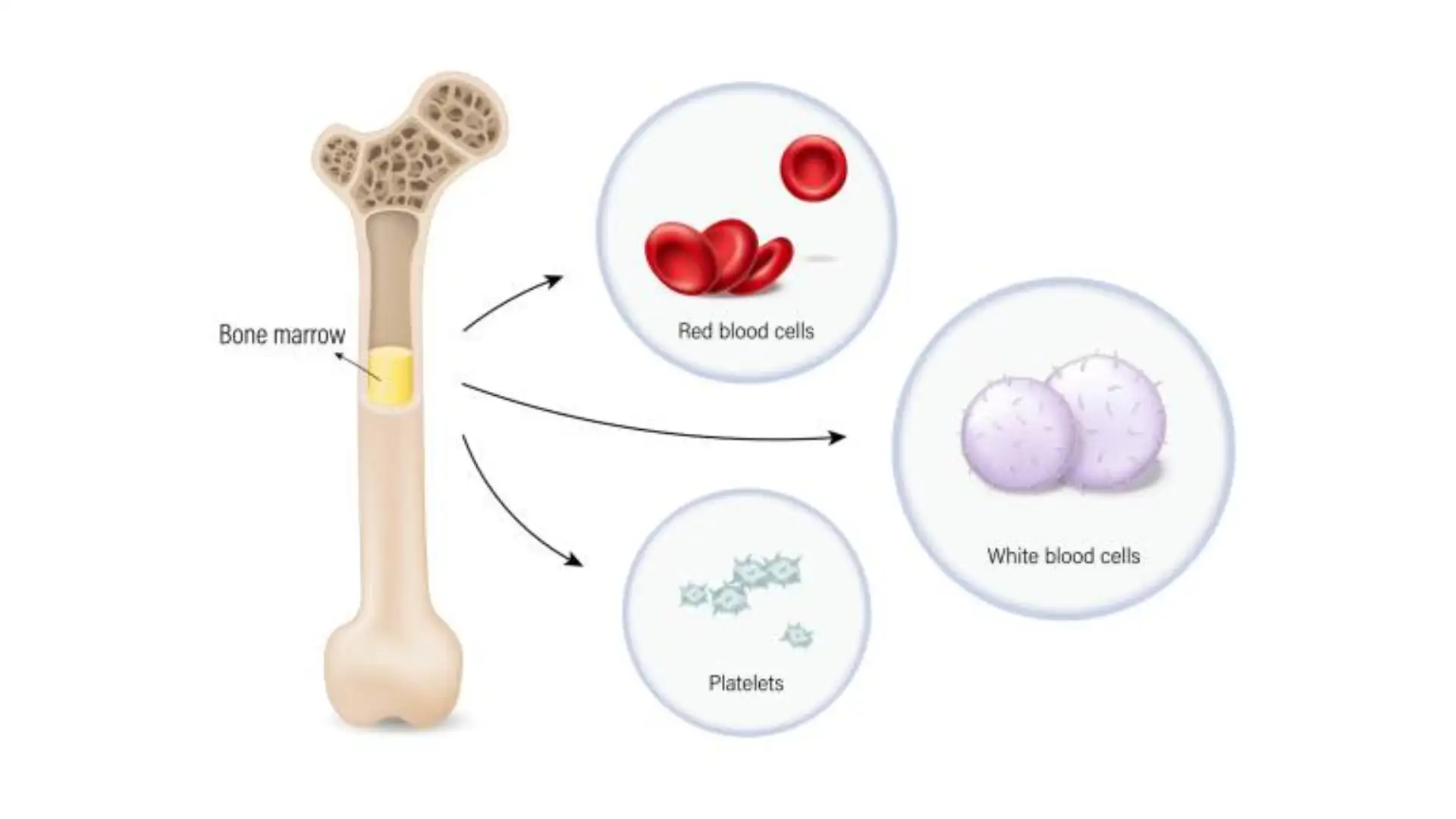 Aplastic anemia