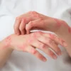 Lyme Disease Causes, Symptoms, Prevention & Research Perspectives