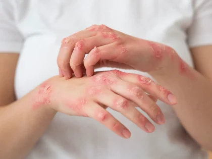 Lyme Disease Causes, Symptoms, Prevention & Research Perspectives