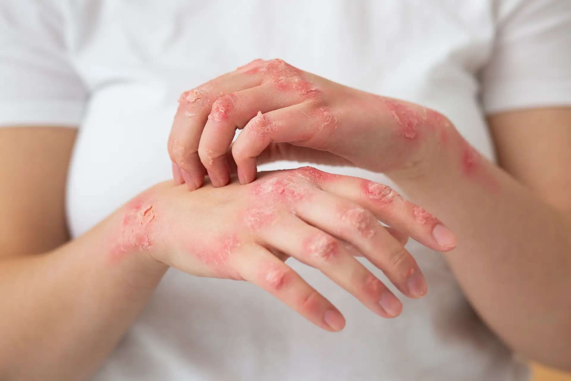 Lyme Disease Causes, Symptoms, Prevention & Research Perspectives