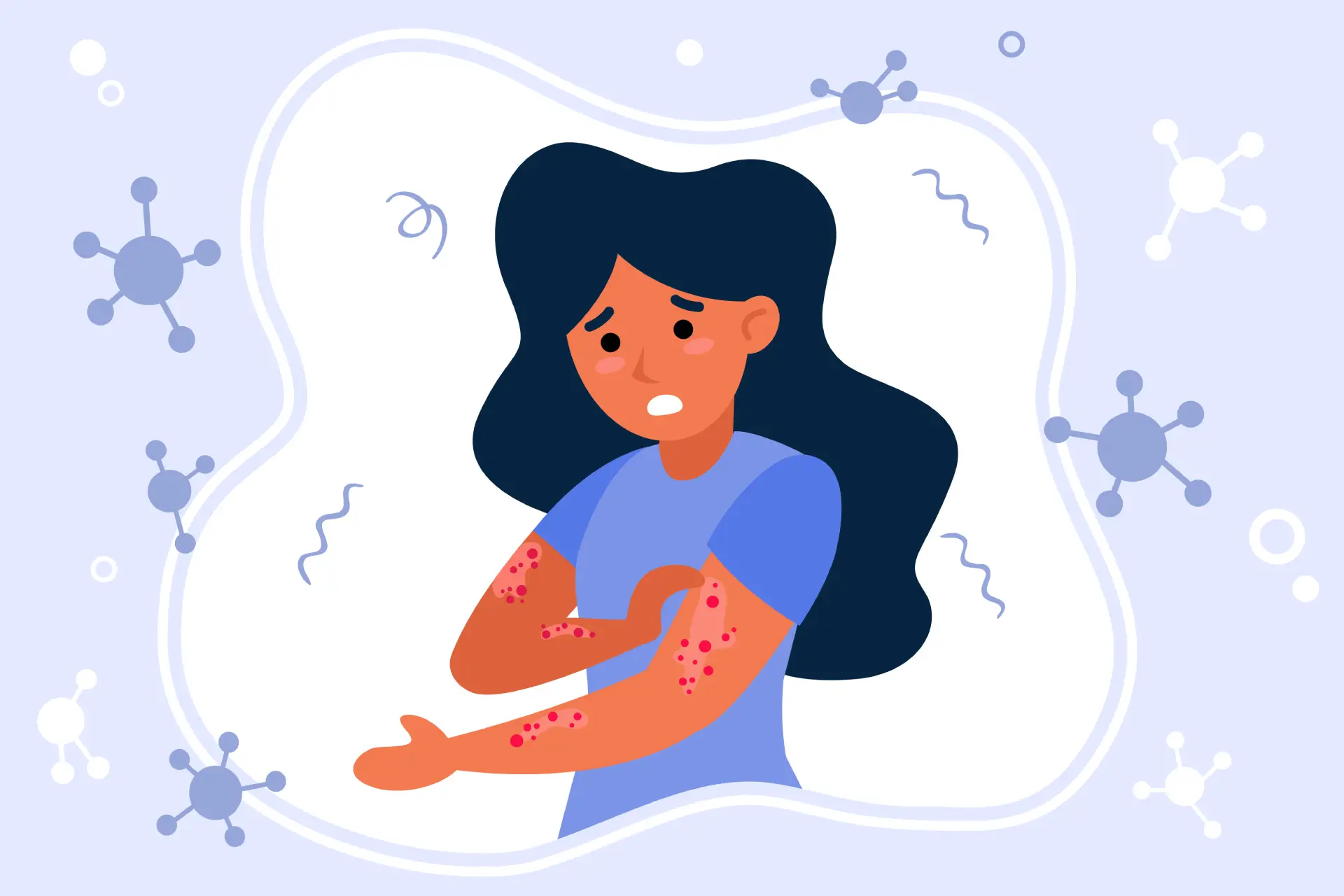How to Prevent Chickenpox In 2025