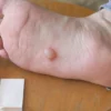 Foot Blister Treatment & Prevention