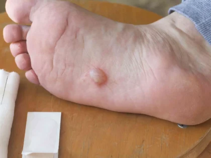 Foot Blister Treatment & Prevention