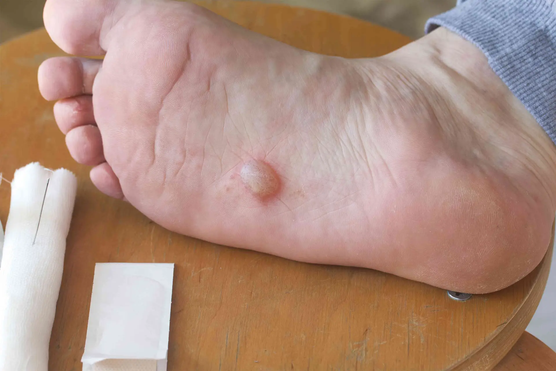 Foot Blister Treatment & Prevention